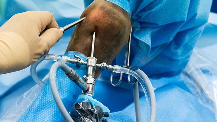 Kirurgisk procedure på et knæ med instrumenter og sterile materialer under operation.