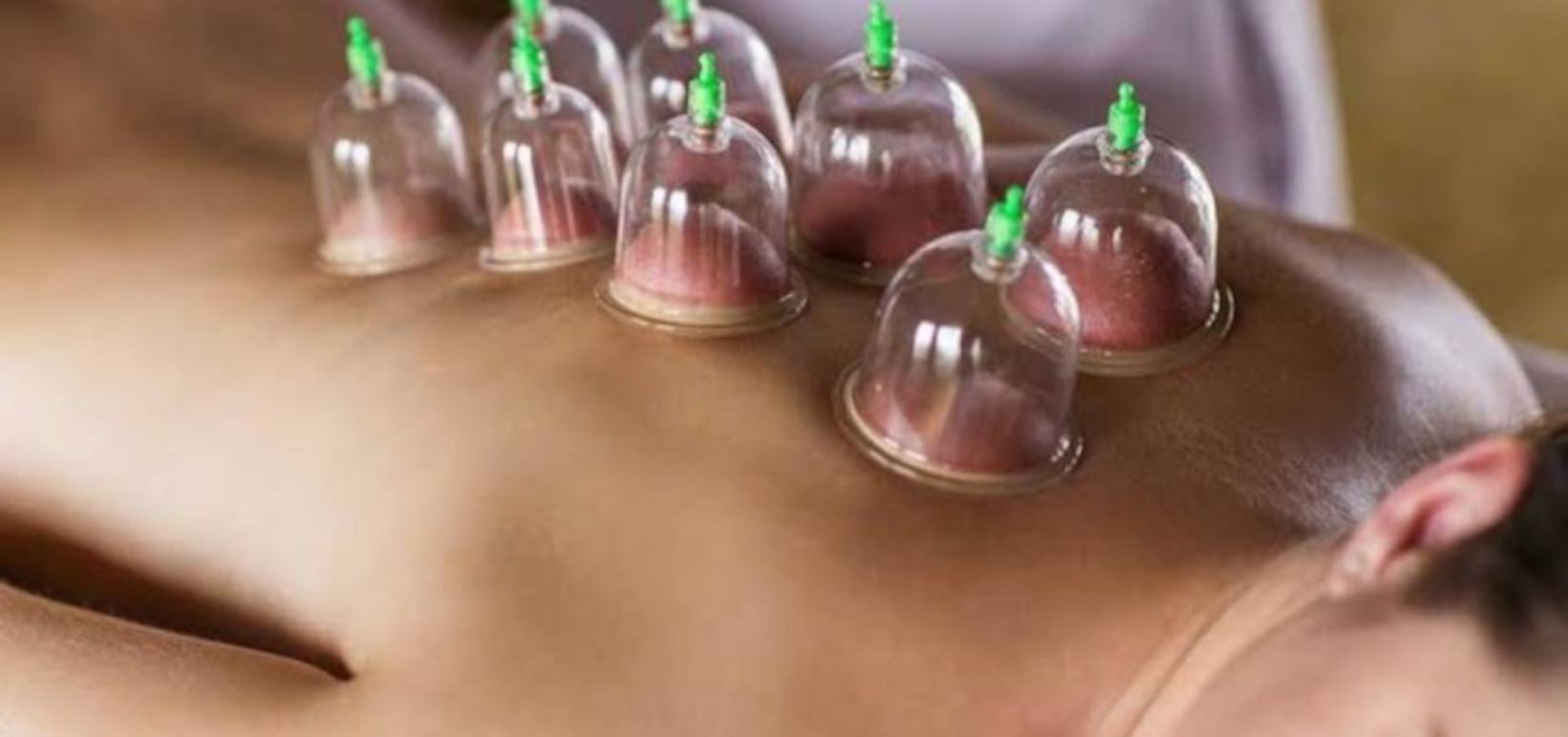 En person får cupping-behandling med glasbeholdere på ryggen for muskelafslapning og smertelindring.