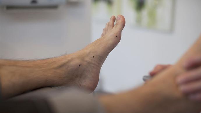 Fod med synlige punkter på huden, mens en person får behandling i en klinik.