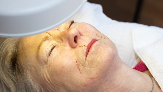 Kvindelig patient under ansigtsbehandling med markerede linjer på huden og lys fra en lampe.