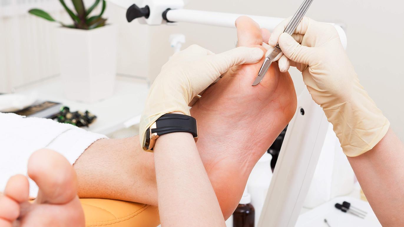 En fodbehandling, hvor en behandler fjerner hård hud fra en patients fod med værktøj.